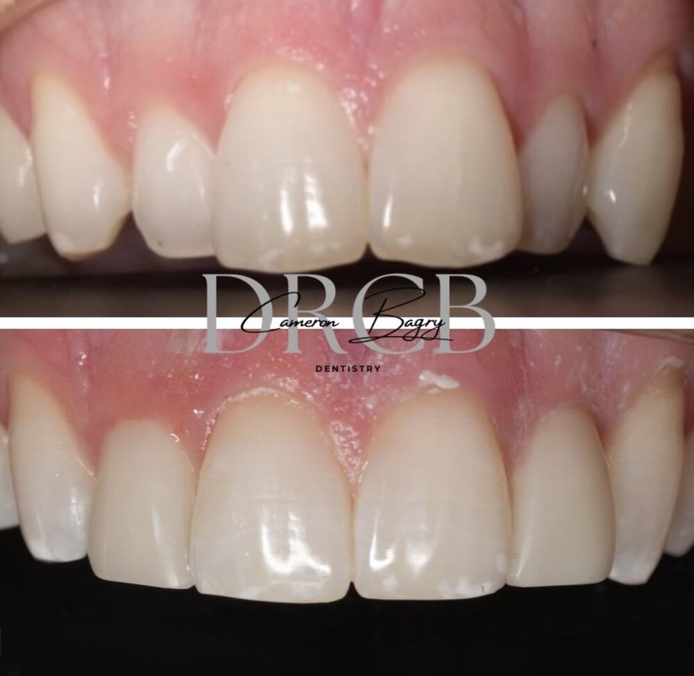 Before and after, composite bonding