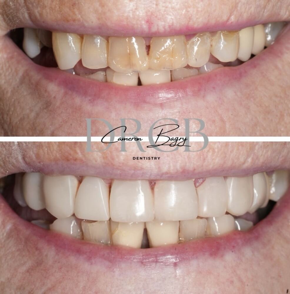 Before and after, composite bonding