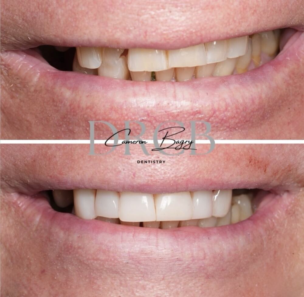 Before and after, composite bonding