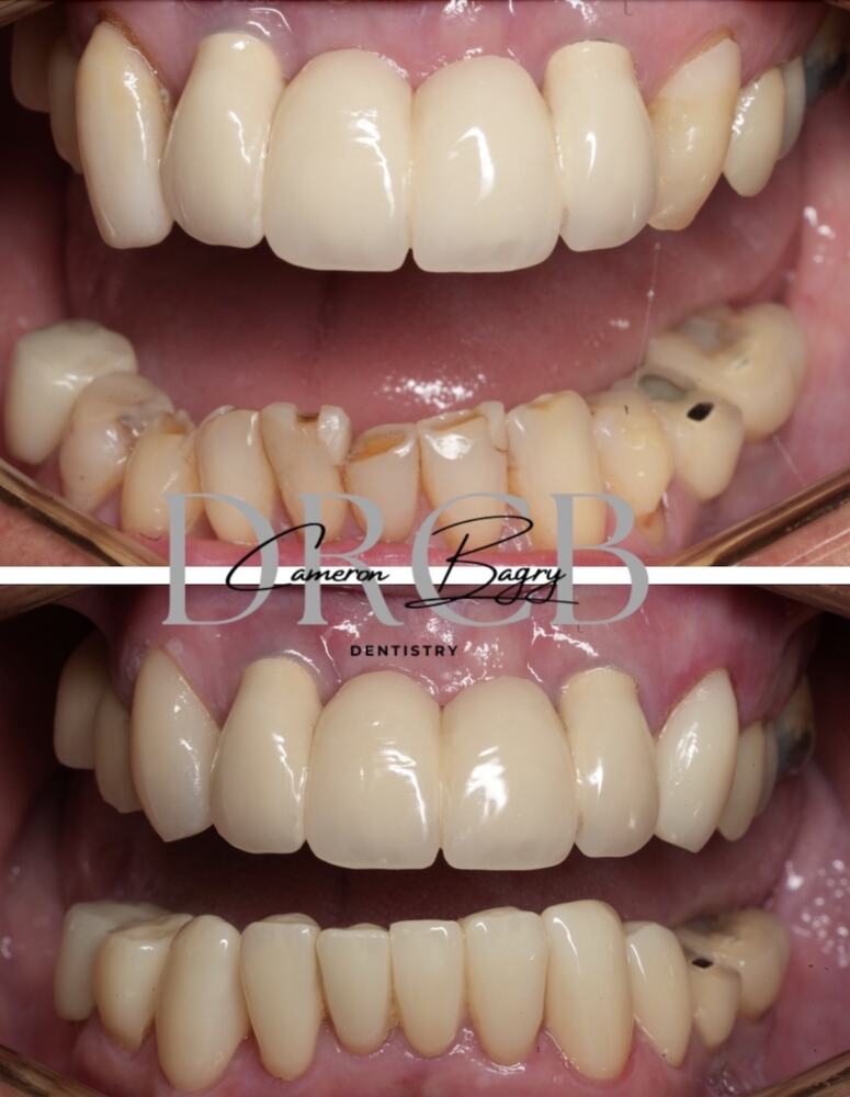 Before and after, full mouth rehabilitation