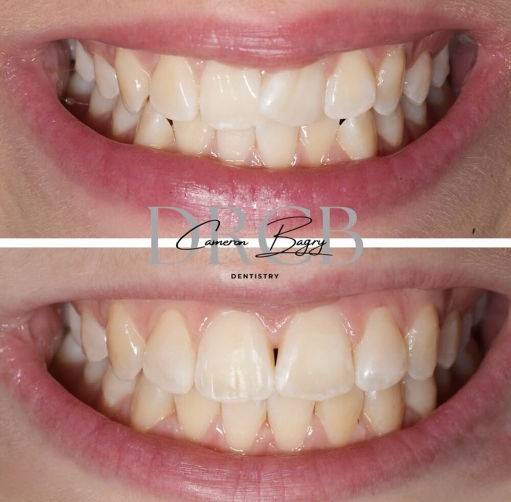 Before and after, Invisalign