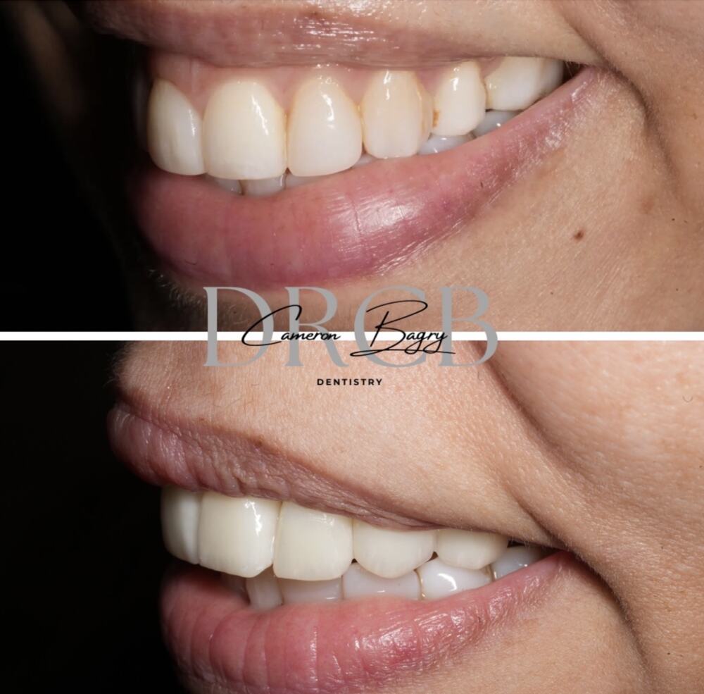 Before and after, prep-less veneers and gummy smile correction